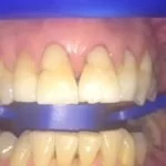 Before thumb