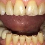 Before thumb